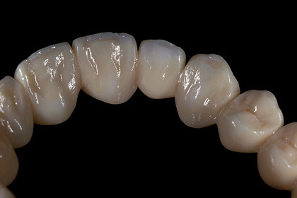 Bild einer Zirkonbrücke