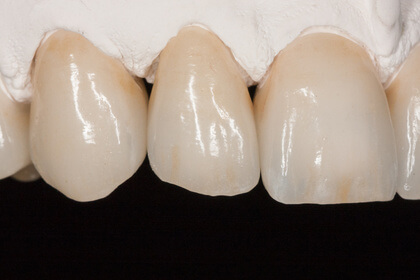 Bild einer Zirkonkrone